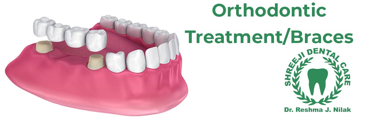 Fixed Teeth(Crown And Bridges)