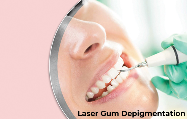 Laser Gum Depigmentation